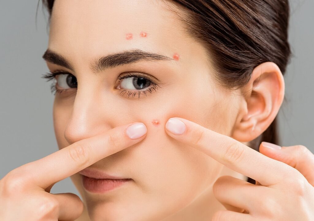 Acné vulgaire : types, symptômes, causes, traitement et plus encore