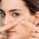 Qu&rsquo;est-ce que l&rsquo;acné (Acné Vulgaire) ?